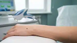 Comment enlever un grain de beauté sans chirurgie ? Une main avec un grain de beauté sur le dos est posée sur une table, avec un appareil médical en arrière-plan pour un traitement non chirurgical.