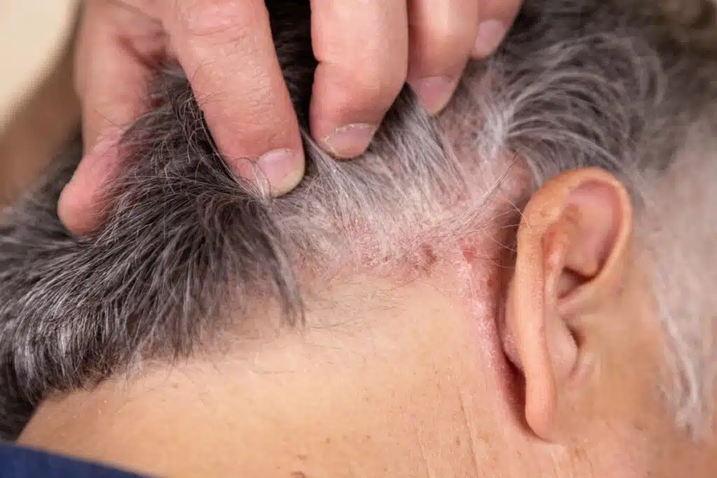 Plaque rouge de psoriasis derrière l'oreille, zone typiquement touchée par le psoriasis du cuir chevelu