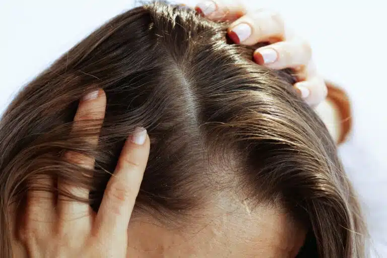 Femme inspectant son cuir chevelu pour vérifier la présence de squames