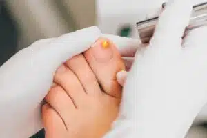 Traitement laser d'une mycose de l'ongle du gros orteil par un professionnel ganté