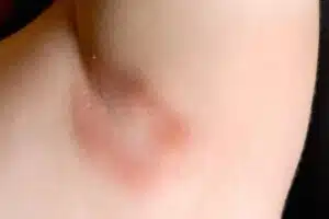 Candidose cutanée avec plaque rouge et macération dans un pli cutané