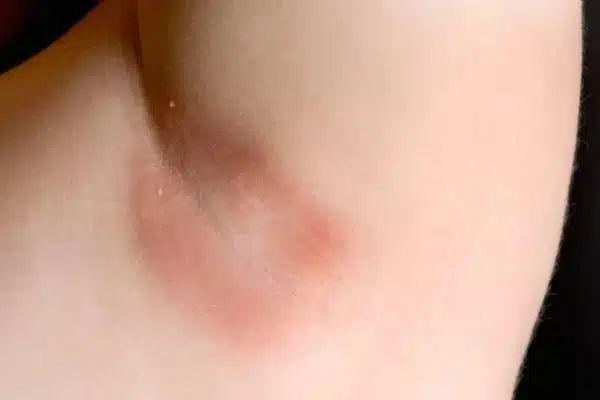 Candidose cutanée avec plaque rouge et macération dans un pli cutané