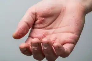 Mains montrant des rougeurs et une peau sèche caractéristiques de l eczéma des mains