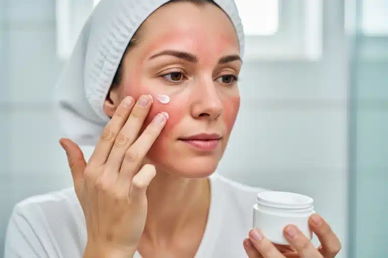 eczéma du visage femme appliquant crème apaisante sur plaques rouges