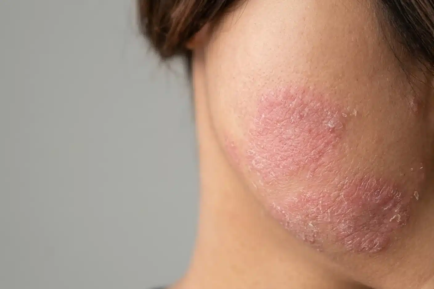 Plaques rouges d'eczéma sur le visage plaques rouges squameuses caractéristiques de l'eczéma du visage sur la joue d'un adulte