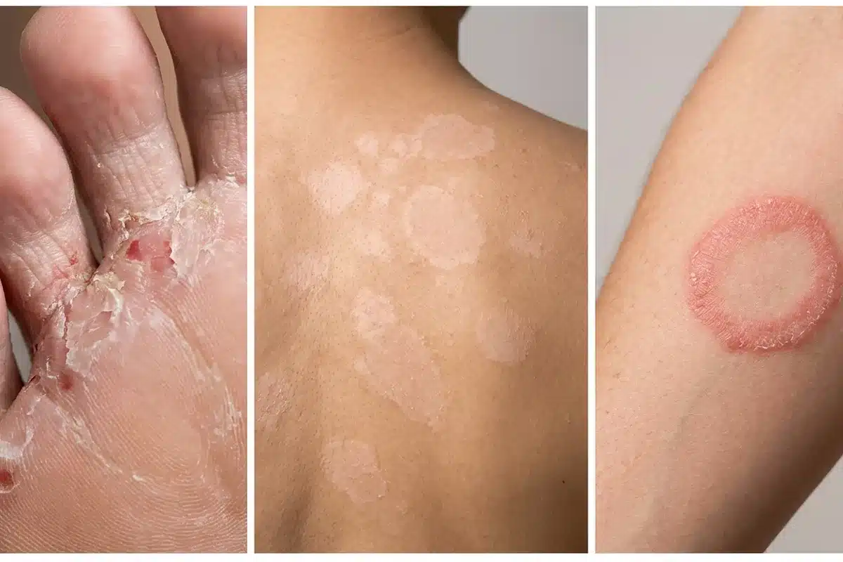 Formes de mycose cutanée Différentes formes de mycose cutanée : pied d'athlète, pityriasis versicolor et herpès circiné sur la peau