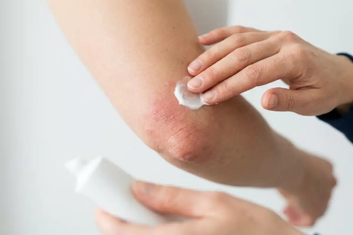 Application de gel AINS sur un coude douloureux Gros plan d'une main appliquant une crème anti-inflammatoire sur un coude rouge (tendinite du coude)