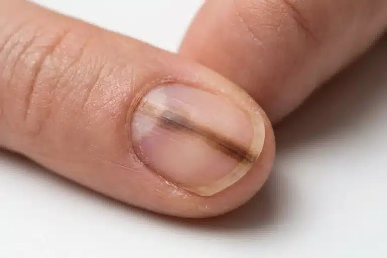 Mélanome ongle débutant : bande pigmentée longitudinale brune sur l'ongle du pouce, illustration médicale
