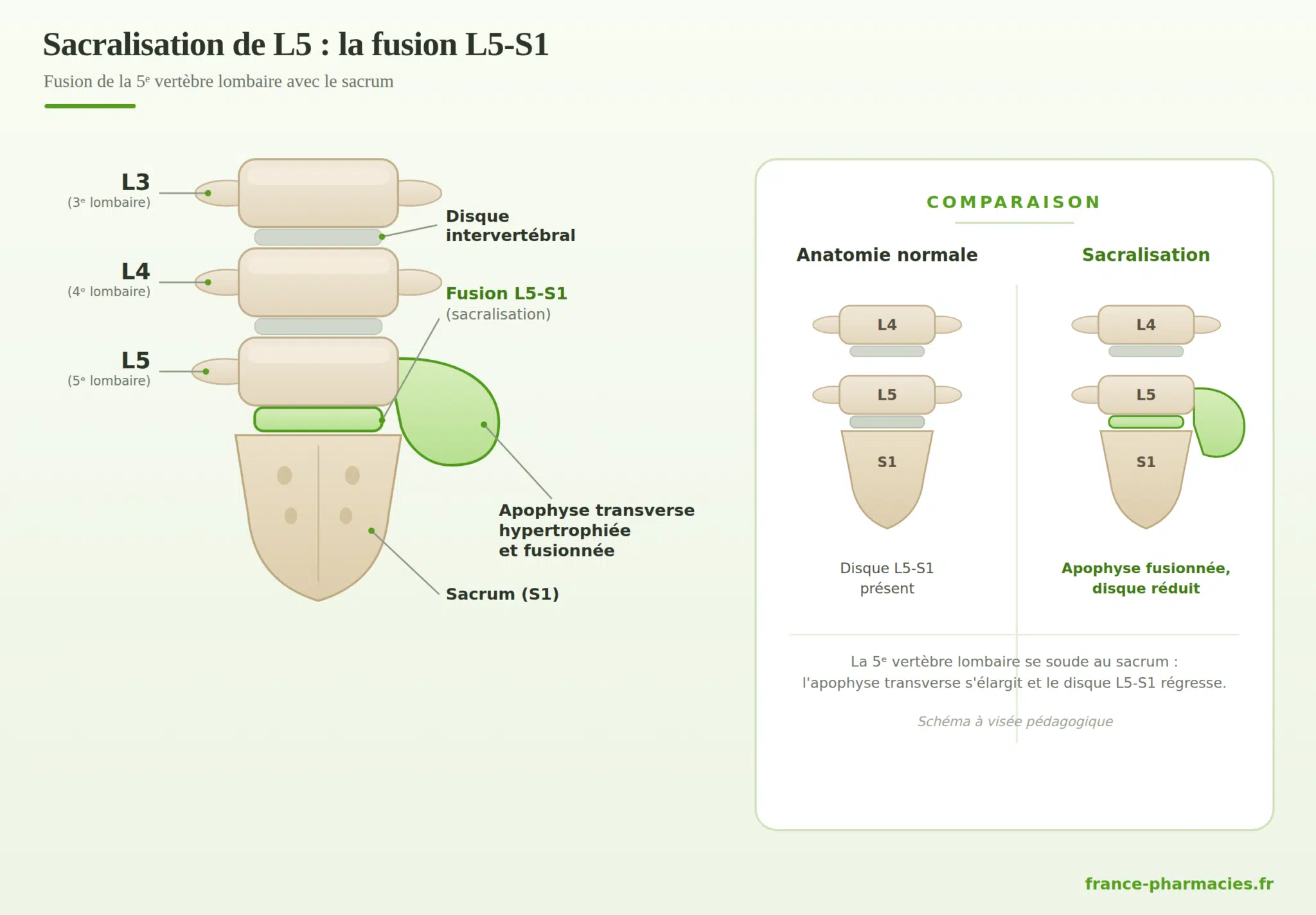 Sacralisation de L5 : schéma de la fusion L5-S1 Schéma de la sacralisation de L5 : fusion de la 5e vertèbre lombaire avec le sacrum, apophyse transverse hypertrophiée et comparaison avec une anatomie normale