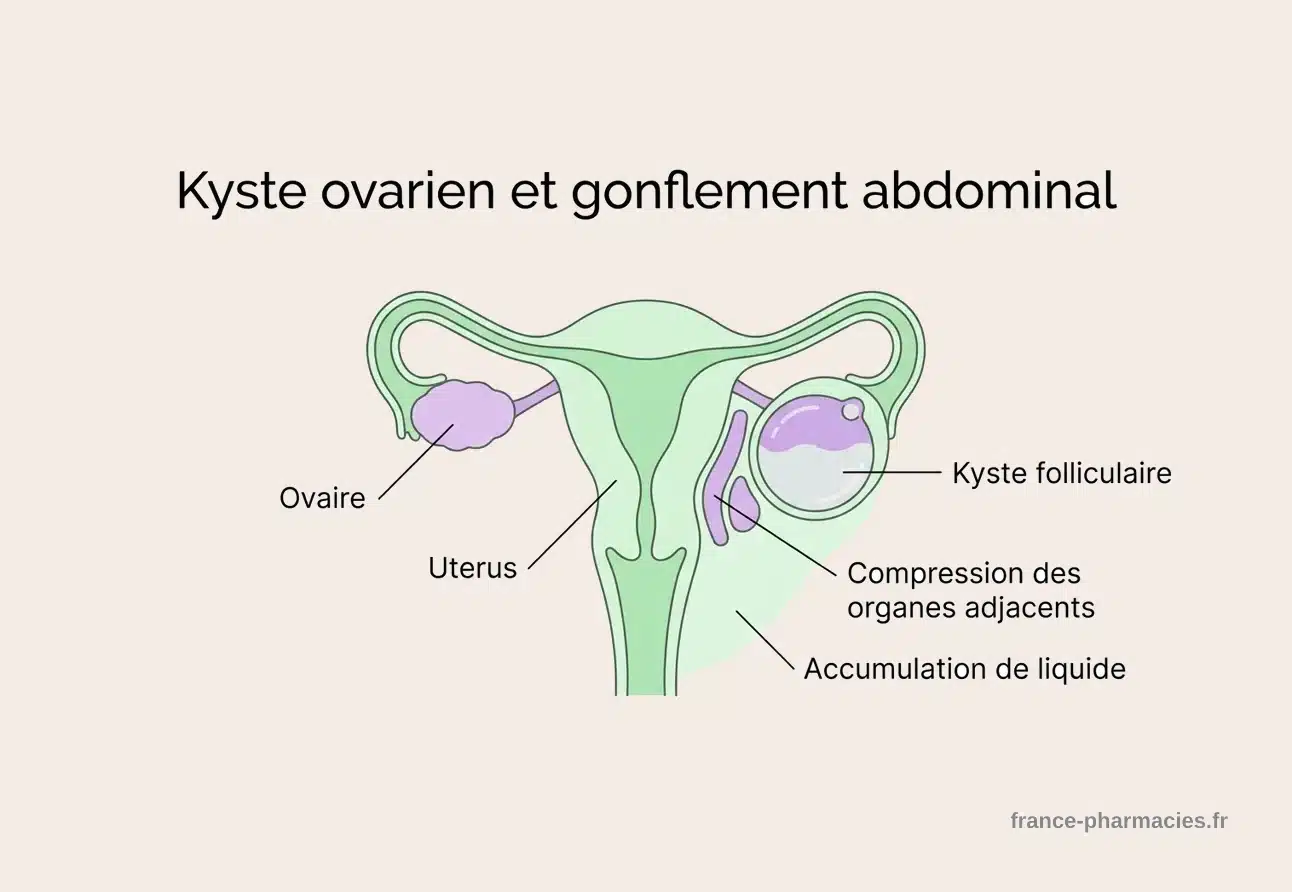 Schéma anatomique kyste ovarien et gonflement abdominal Schéma anatomique illustrant un kyste folliculaire sur l'ovaire et la compression des organes voisins responsable du ventre gonflé